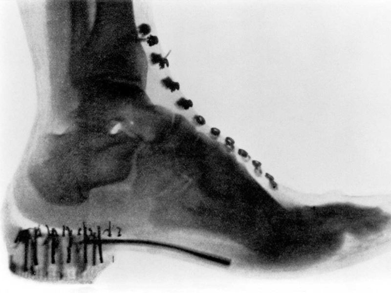 Department Store Shoe Fitting with X-Rays